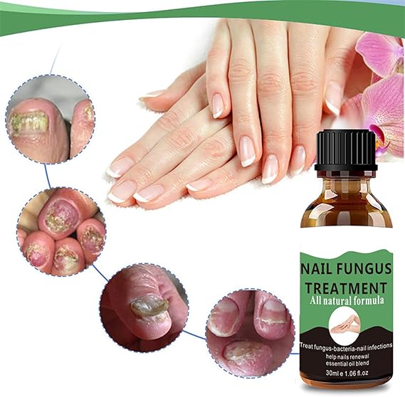 Fungal Nail Treatment - Extra Strong Nail Fungus Treatment for Toenail and Fingernail - Anti fungus Nail Repair and Strengthen, Fix & Renew Damaged, Broken Nails