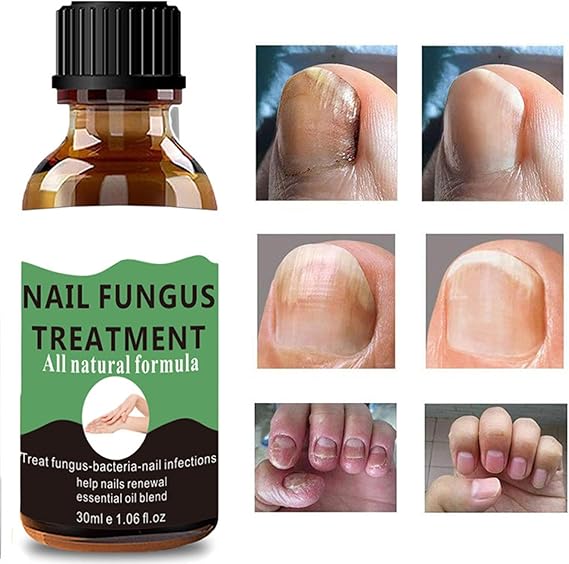Fungal Nail Treatment - Extra Strong Nail Fungus Treatment for Toenail and Fingernail - Anti fungus Nail Repair and Strengthen, Fix & Renew Damaged, Broken Nails