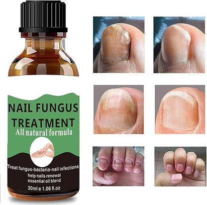 Fungal Nail Treatment - Extra Strong Nail Fungus Treatment for Toenail and Fingernail - Anti fungus Nail Repair and Strengthen, Fix & Renew Damaged, Broken Nails
